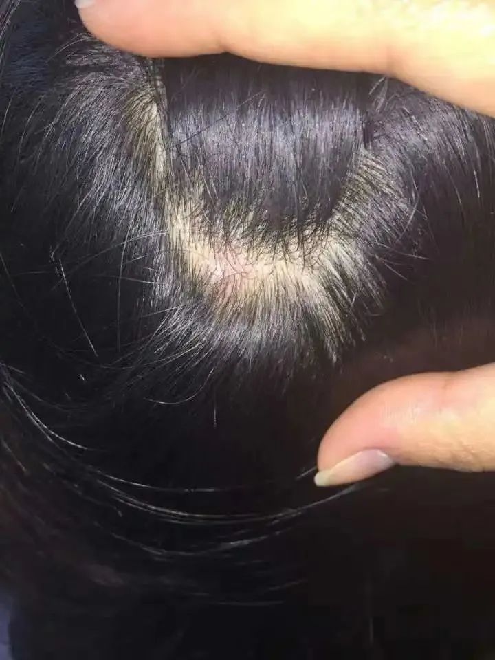 银屑病头皮屑症状中医,银屑病头屑增多是好转还是加重