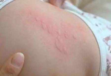 用炉甘石洗剂后可以用药吗,炉甘石是四类药品吗