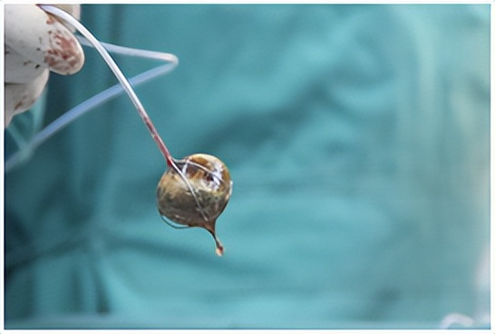 胆囊结石如果一直没症状怎么处理,胆囊结石久拖不治