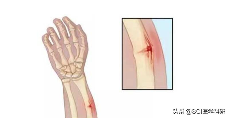 孩子不小心骨折,孩子不小心摔伤了怎么安慰孩子