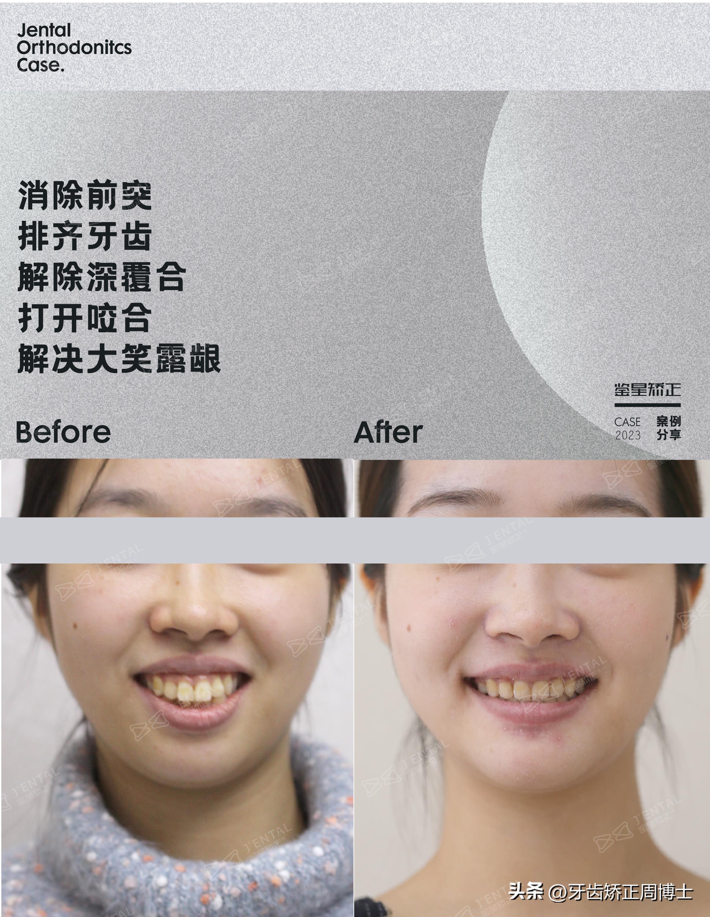 龅牙骨钉矫正演示,骨性龅牙打骨钉前后对比