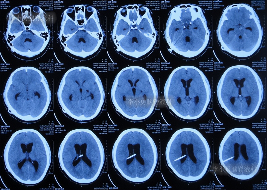 脑积水三脑室造瘘多久能恢复,脑囊虫手术后脑积水