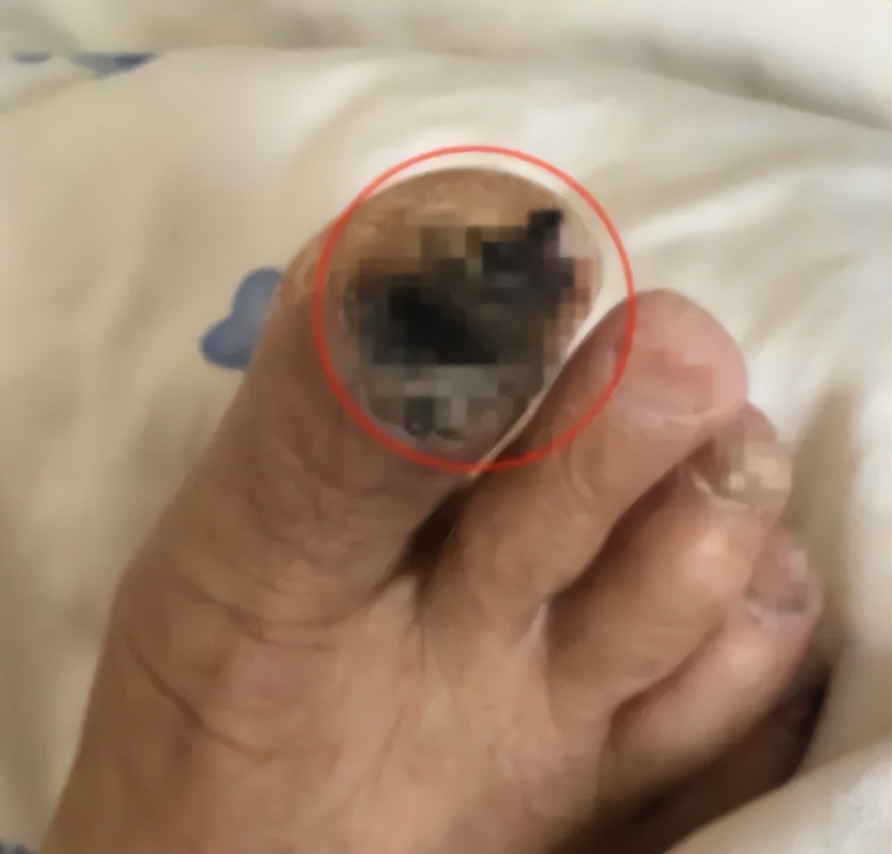 指甲上有血点是癌症的前兆,癌症的指甲早期信号