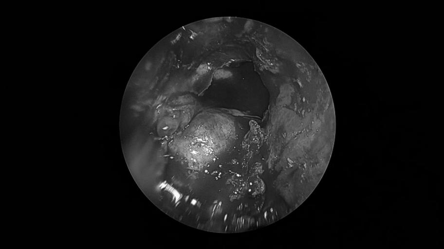 南昌二附院耳鼻喉科手术,南昌大学第二附属医院耳鼻咽喉科