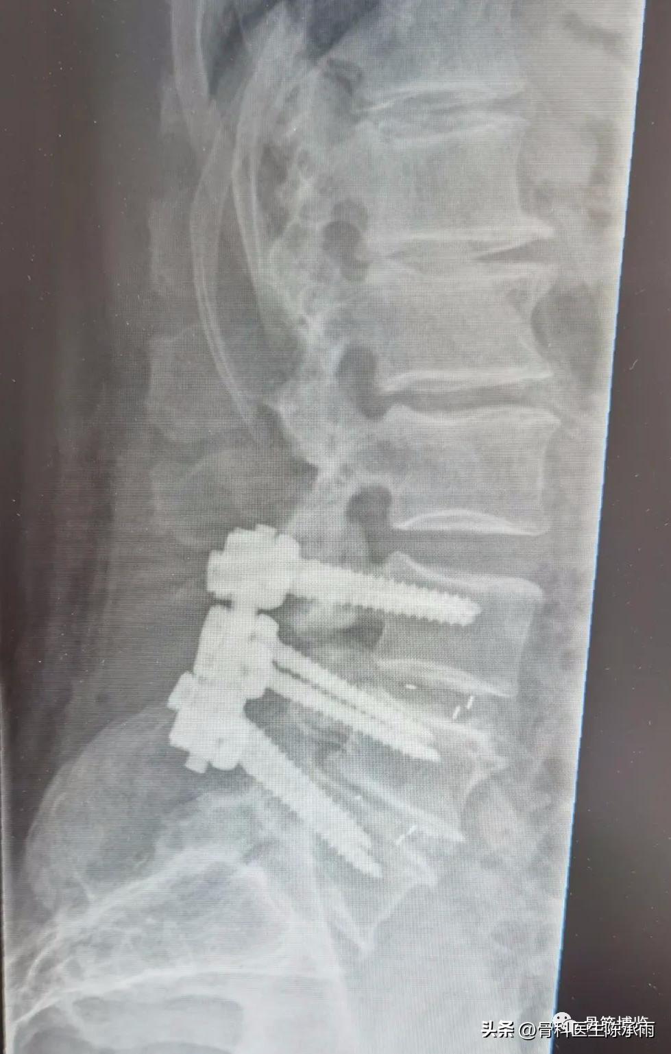 腰椎滑脱椎管狭窄手术后遗症,腰椎间盘突出椎管狭窄的手术