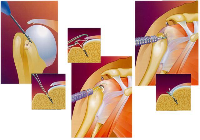 肩膀疼运动一下,运动肩膀疼痛怎么治疗最快最好