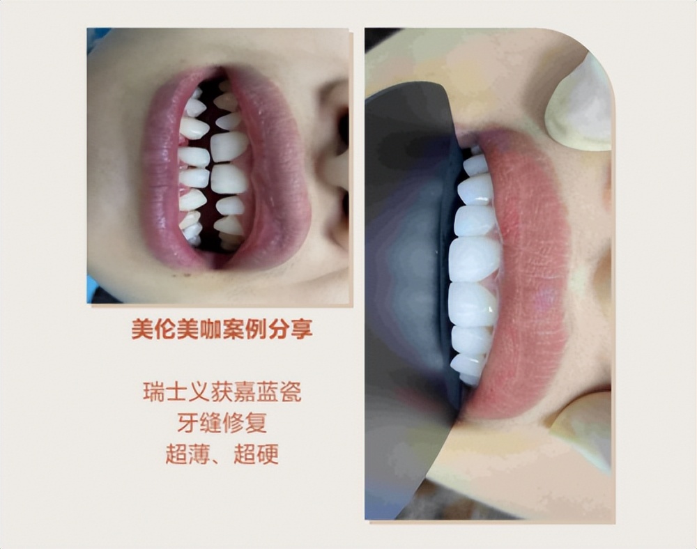 你需不需要做美牙，美伦美咖：这个问题该问谁？