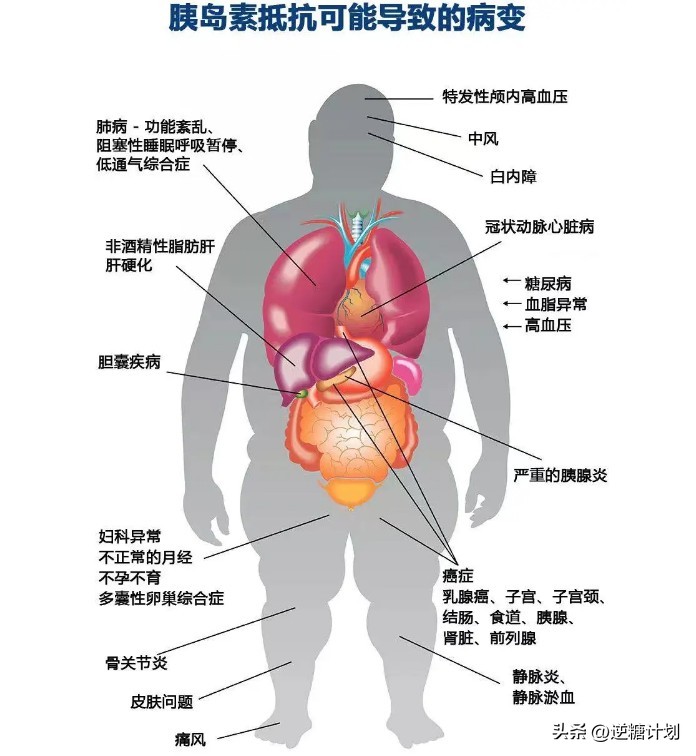 胰岛素水平过高是什么原因,胰岛素高怎么下降