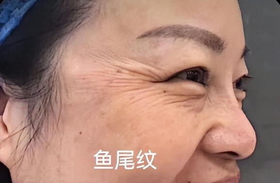 鸡爪纹和鱼尾纹怎样祛除,鱼尾纹和鸡爪纹是一个意思吗