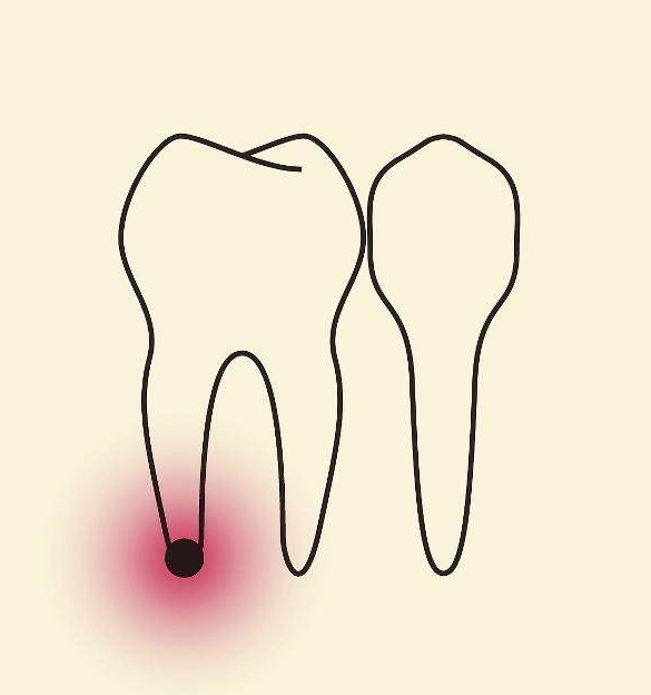 蛀牙到什么程度必须拔掉,蛀牙碰到神经了一定要做根管吗