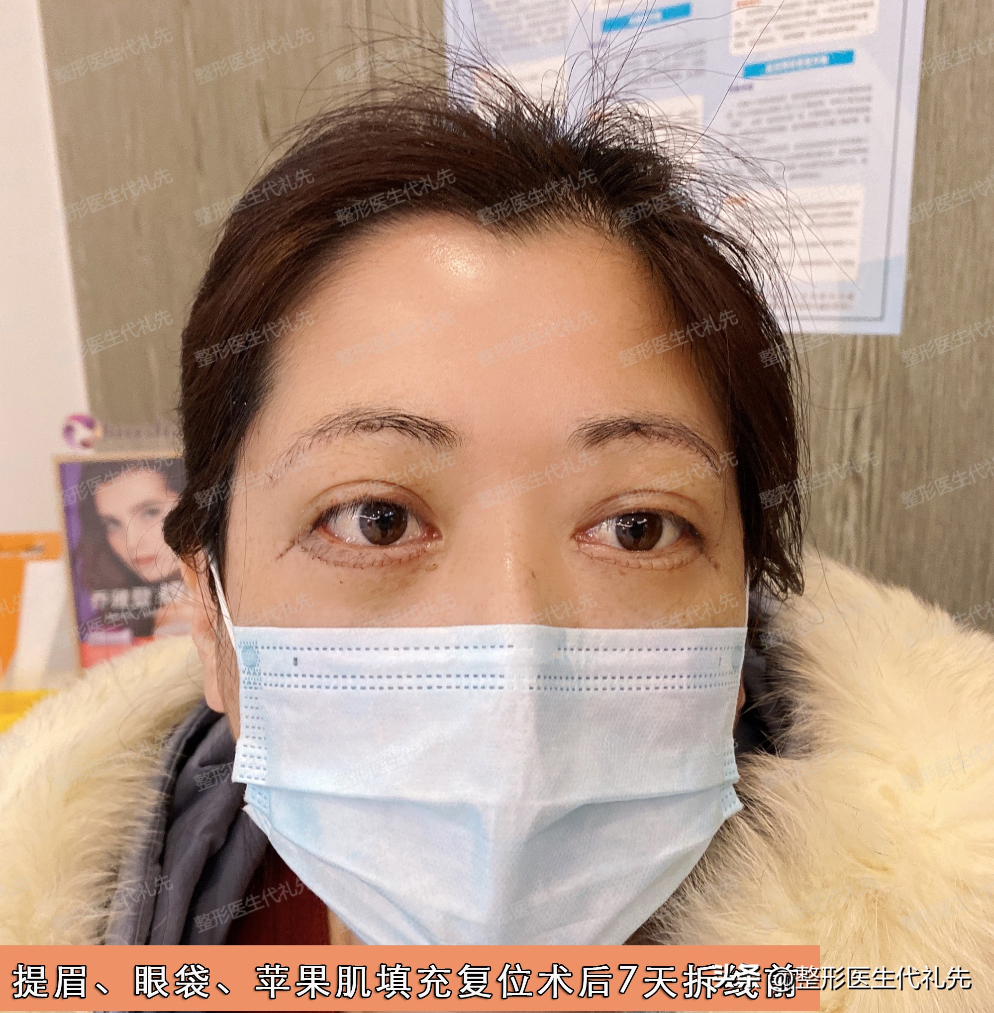 祛眼袋手术后凹陷多久恢复好,祛眼袋手术后眼眶处出现凹陷