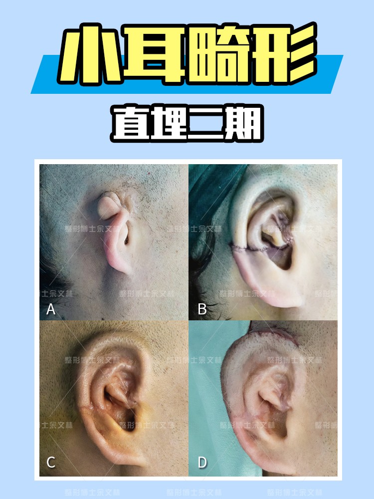 小耳畸形做耳再造哪位医生技术好,小耳畸形手术10年后效果图