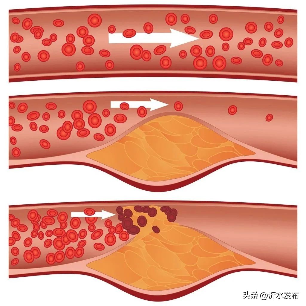 医生科普斑块逆转的关键是什么,逆转斑块最好的方法