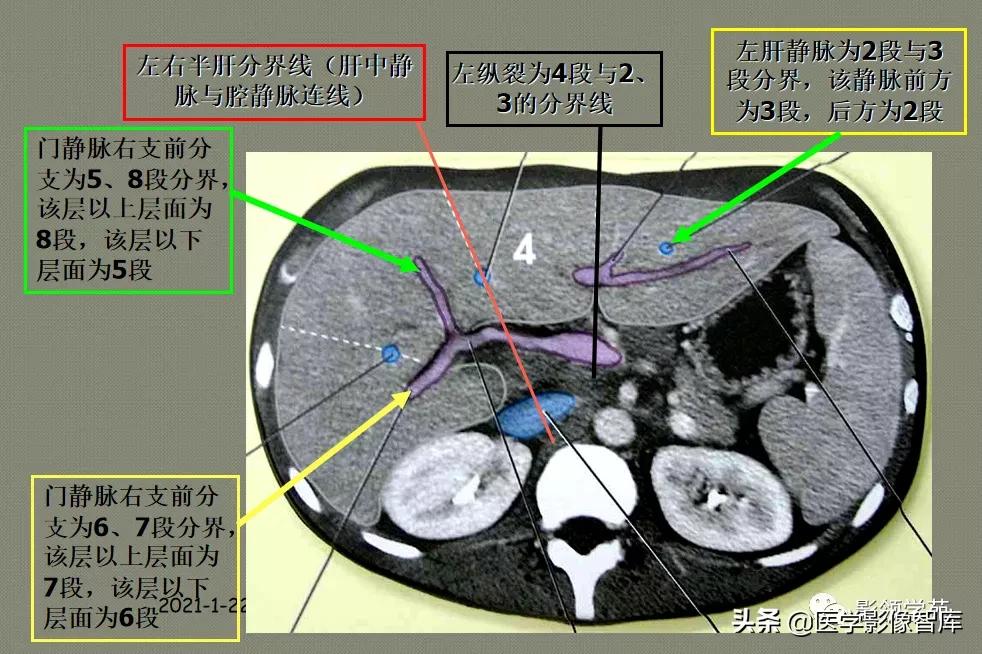 肝脏影像分叶分段解剖图,肝脏分段解剖图谱