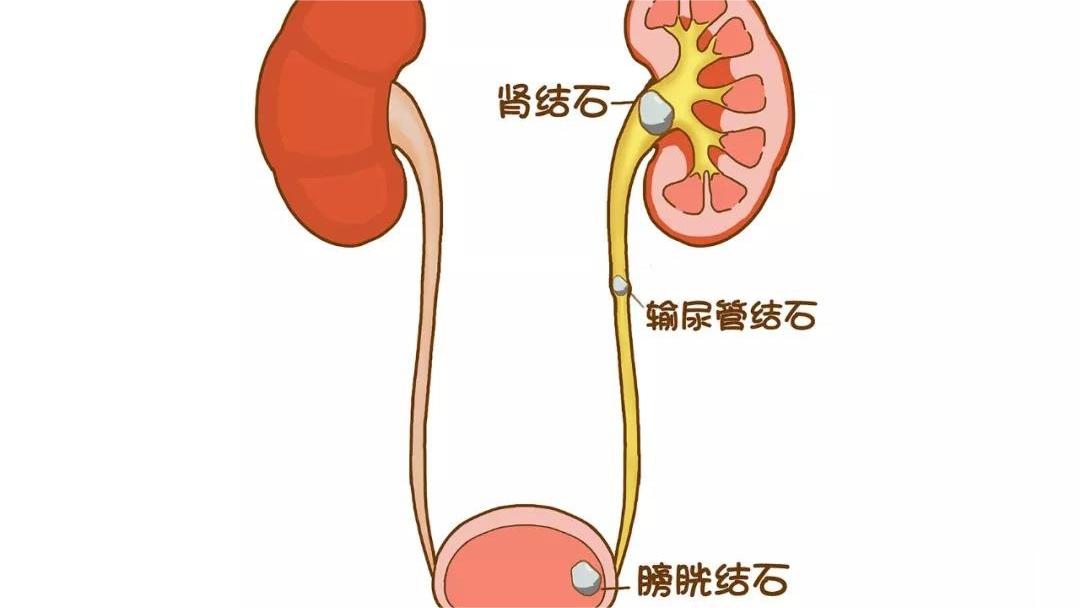b超检查肾脏结晶怎么办,B超检查肾结晶与小结石怎么区分