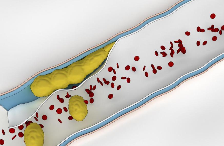 血压高危害及成因,低压高的危害和严重性