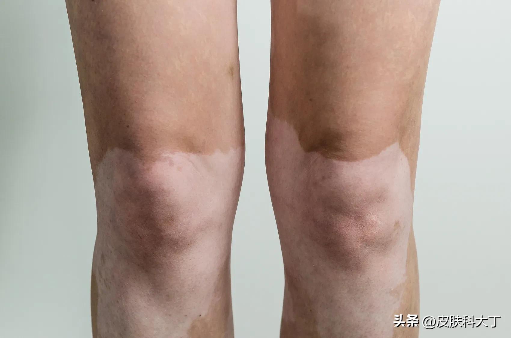 怎么让白癜风黑色素全部退掉,手上白癜风最佳治疗方法