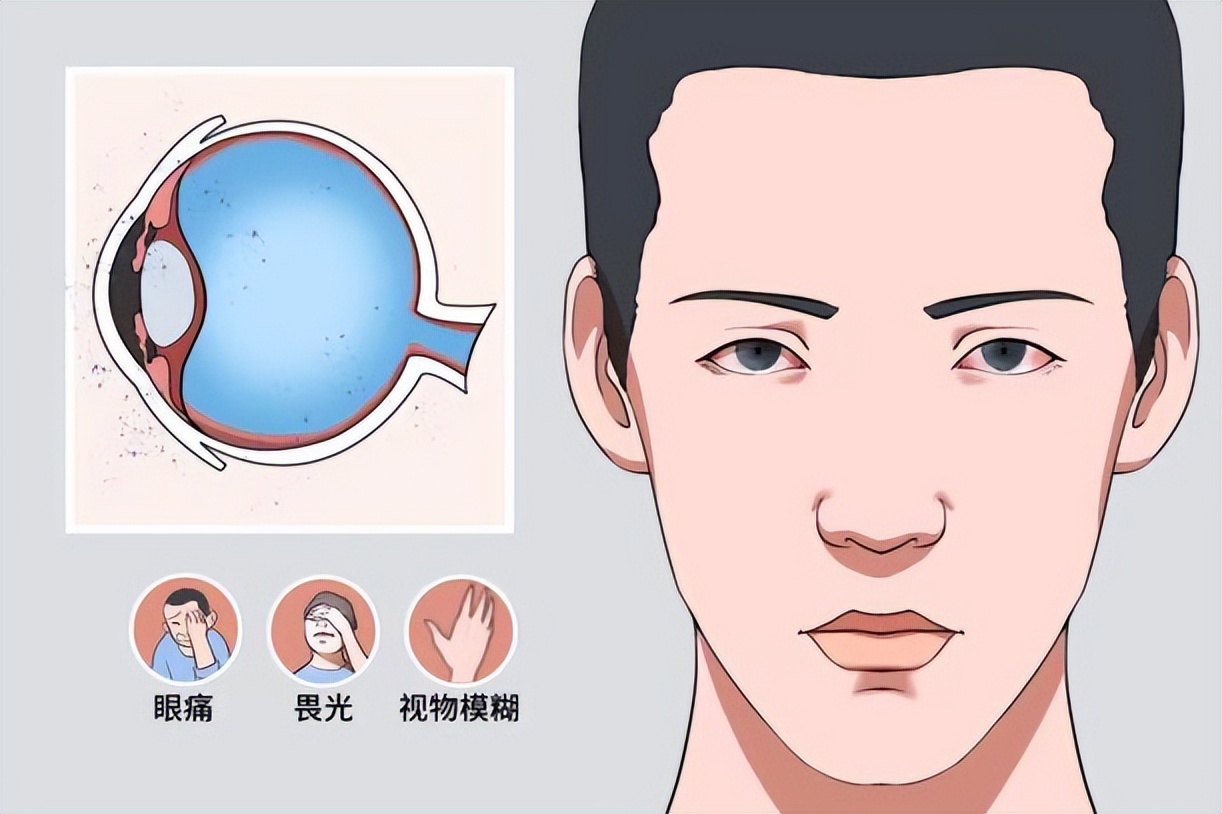 眼干眼涩眼模糊不清吃啥药,眼干眼涩看不清怎么治