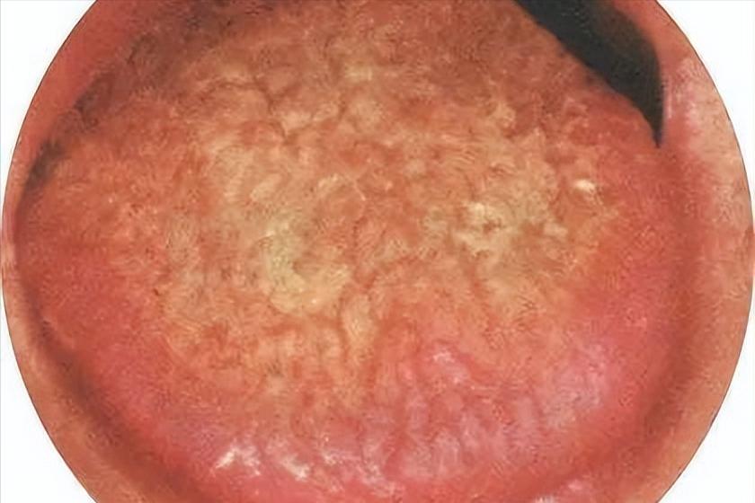 中医辨证治疗体内老痰病根未除,老中医治白痰的最佳方法