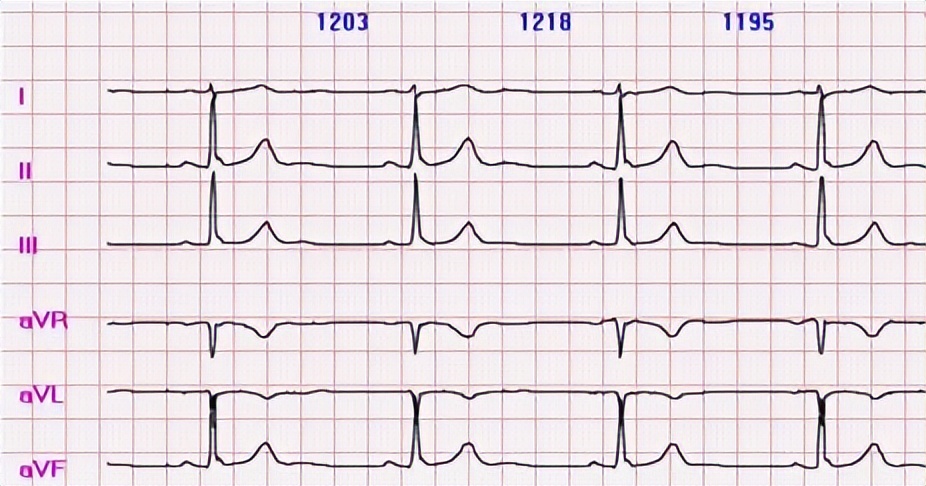 心脏心律不齐是什么原因引起的,心律不齐是心脏病吗吃什么药治