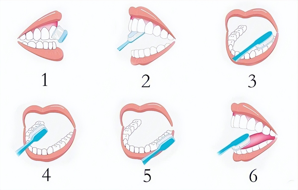 蛀牙如何防止牙齿继续蛀下去,蛀牙治疗后注意事项及饮食