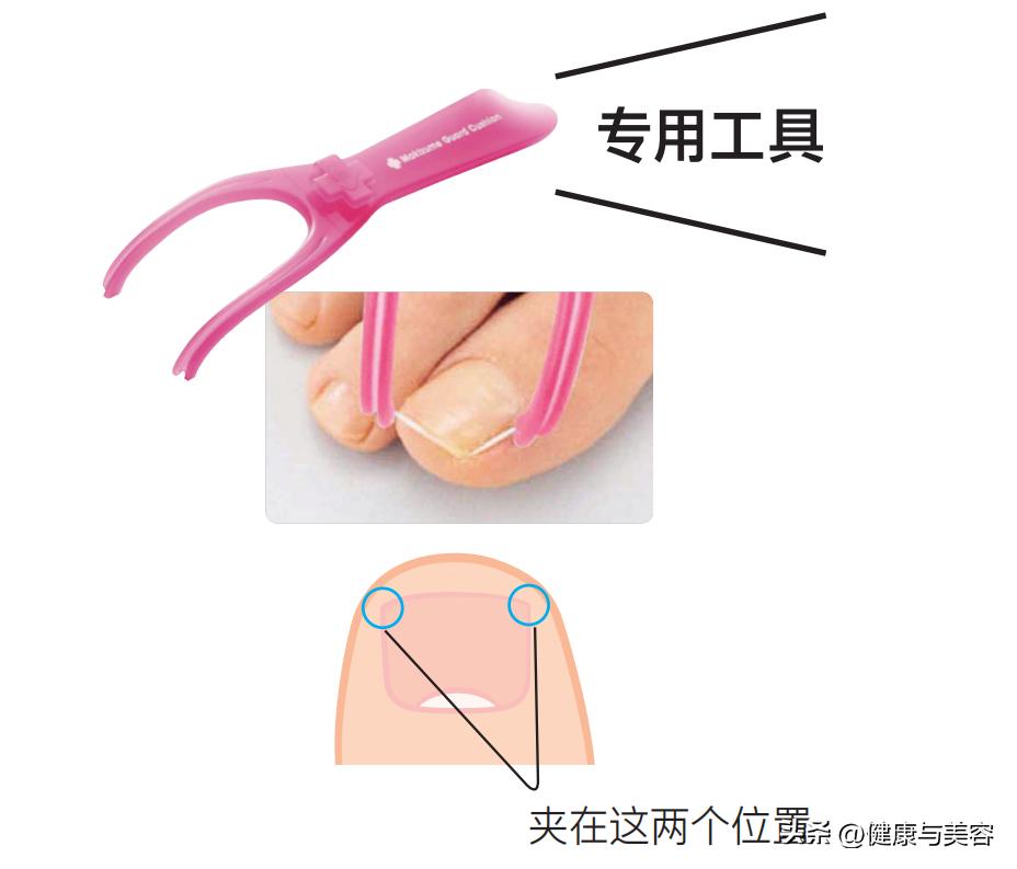 指甲卷曲内卷,指甲卷曲用什么药