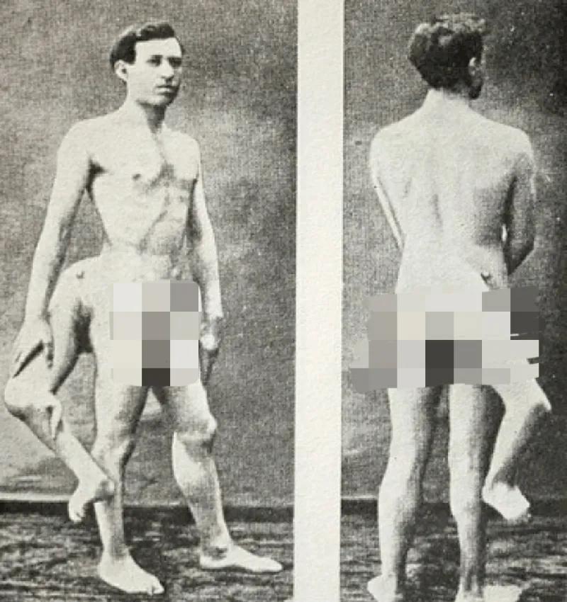 弗兰克伦蒂尼,弗兰克三条腿