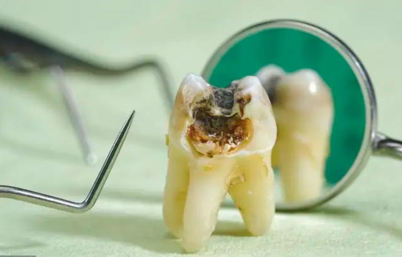 牙齿补过了为什么还老发炎,牙齿补好后会继续蛀牙吗