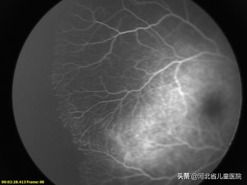 河北省眼科医院小儿眼科看眼流程,河北儿童眼科十大排名