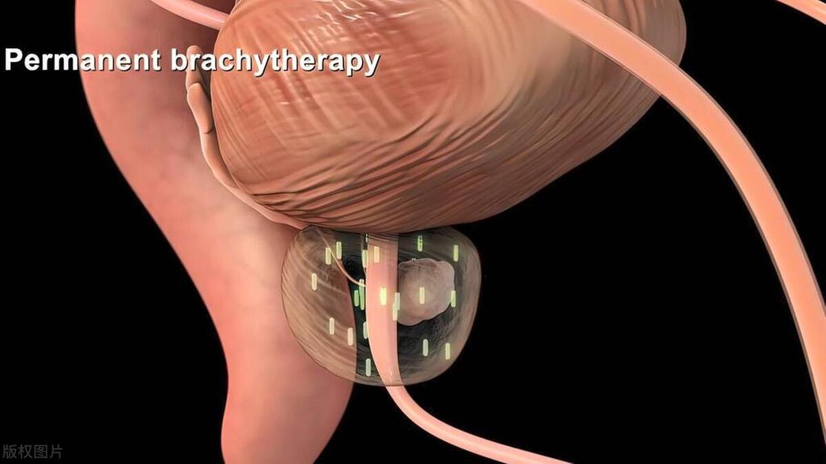 我老公得了膀胱癌怎么办,我老公得了肝癌我需要做什么检查