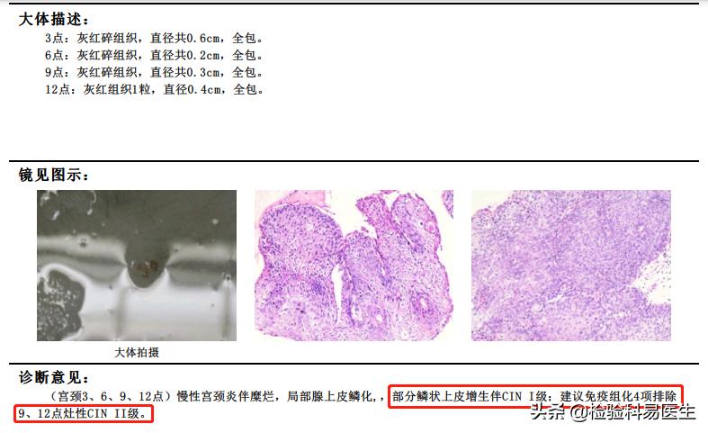 女性宫颈病变怎么引起的,hpv阴性为什么会宫颈高度病变