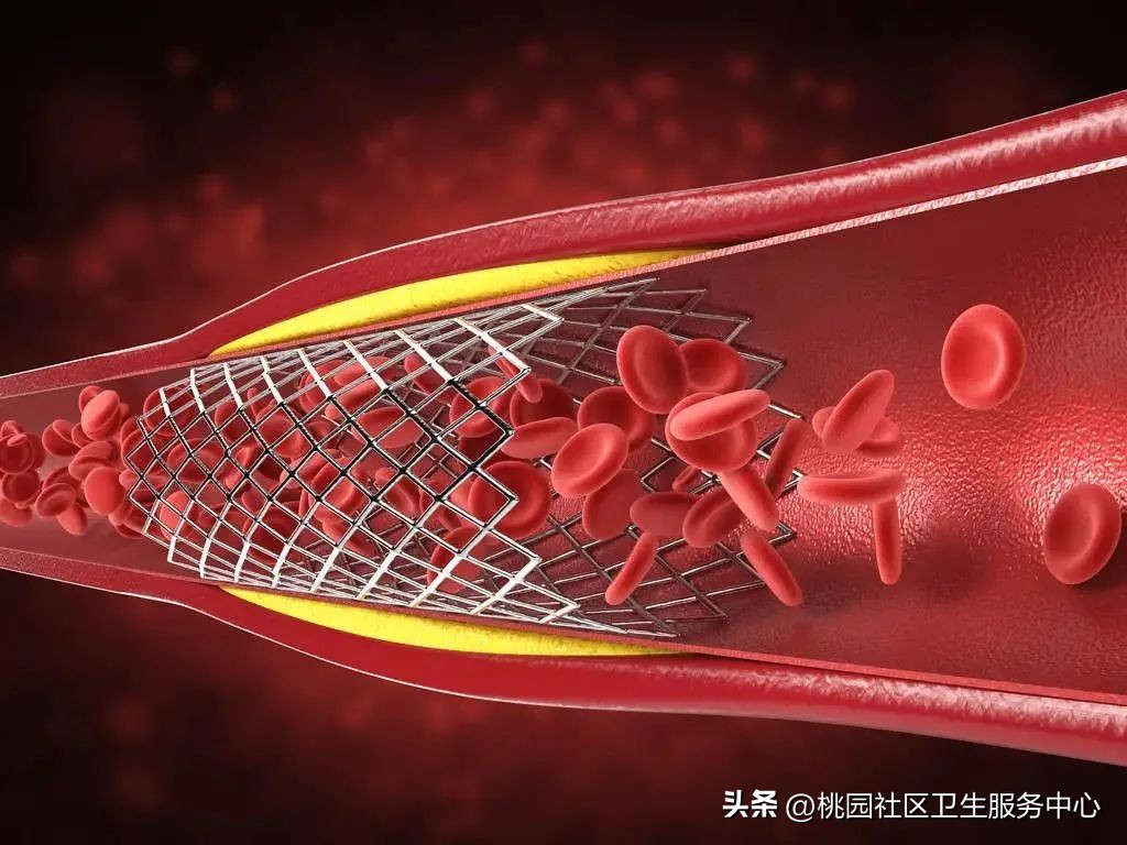 后循环梗死的识别,梗死分为哪三大类型