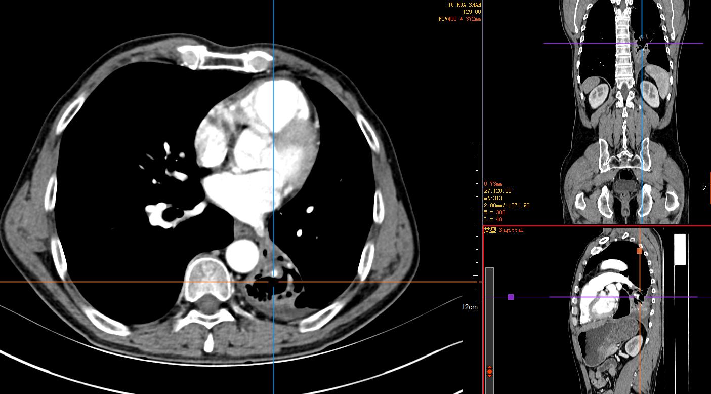 免疫治疗6次后肿瘤消失了,肺鳞癌中晚期化疗联合免疫治疗