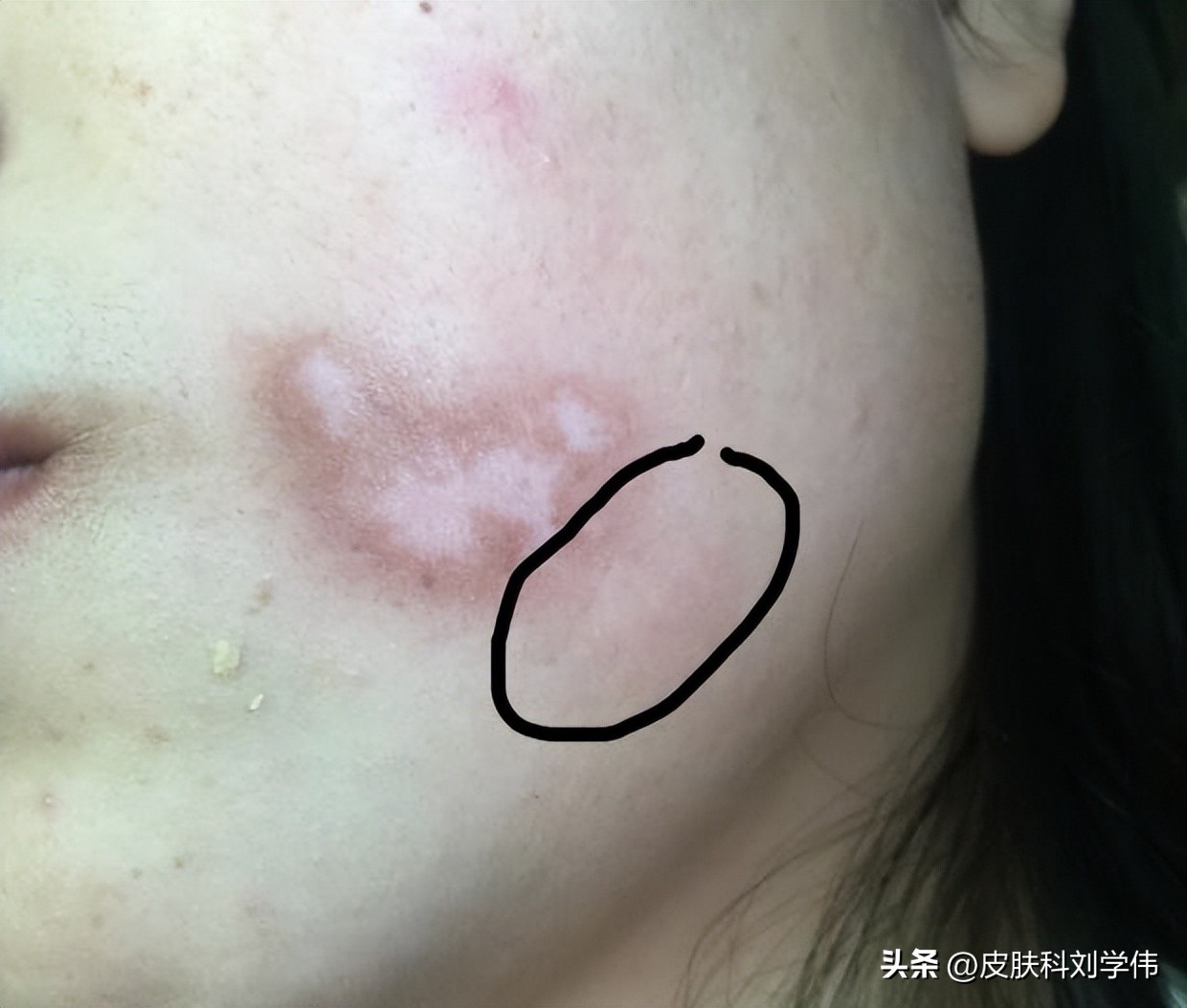 10岁女孩脸上白斑6年，妈妈彻夜难眠，医生一句话让她心安