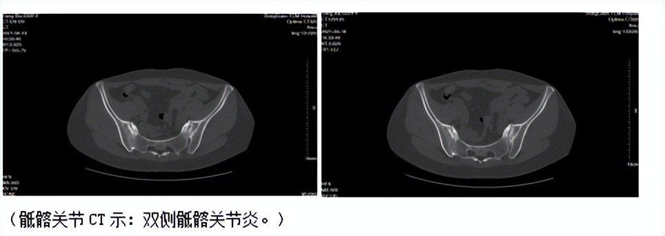 阿达木单抗治疗强直性脊柱炎案例,类风湿合并强直哪个药最好