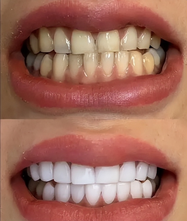 牙黄口臭用什么牌子牙膏最有效,牙黄口臭用什么牙膏小视频