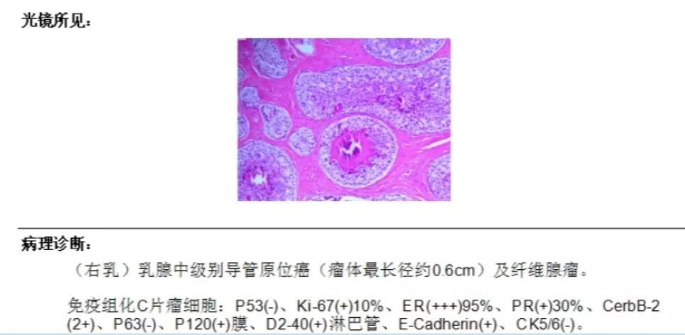 联合检查达到的效果,合并导管原位癌