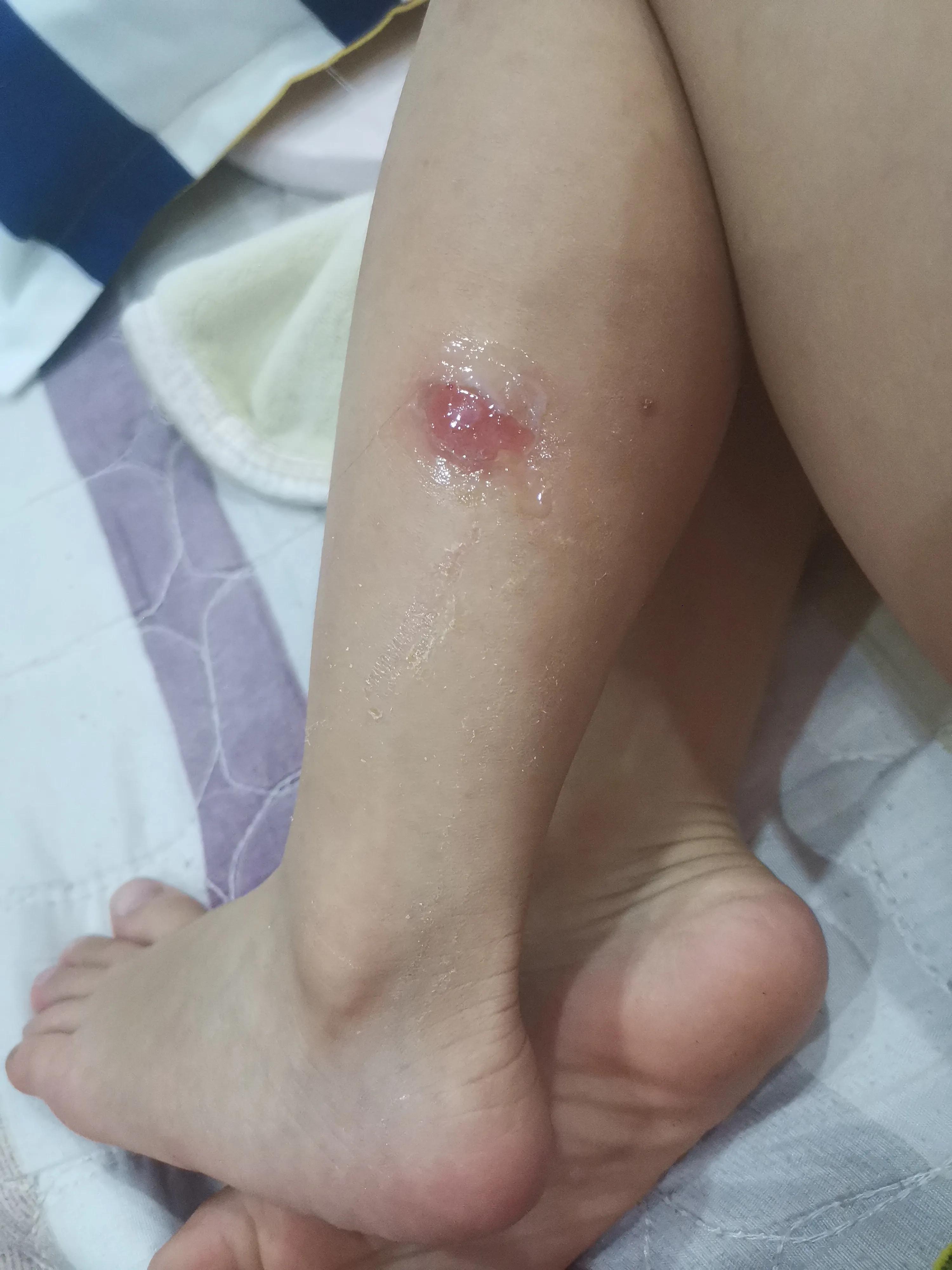 什么虫子咬了伤口像烫伤,被虫子咬了伤口愈合不了