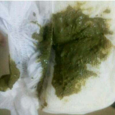 母乳新生儿大便是怎样的,新生儿喝母乳大便黑色黏糊糊