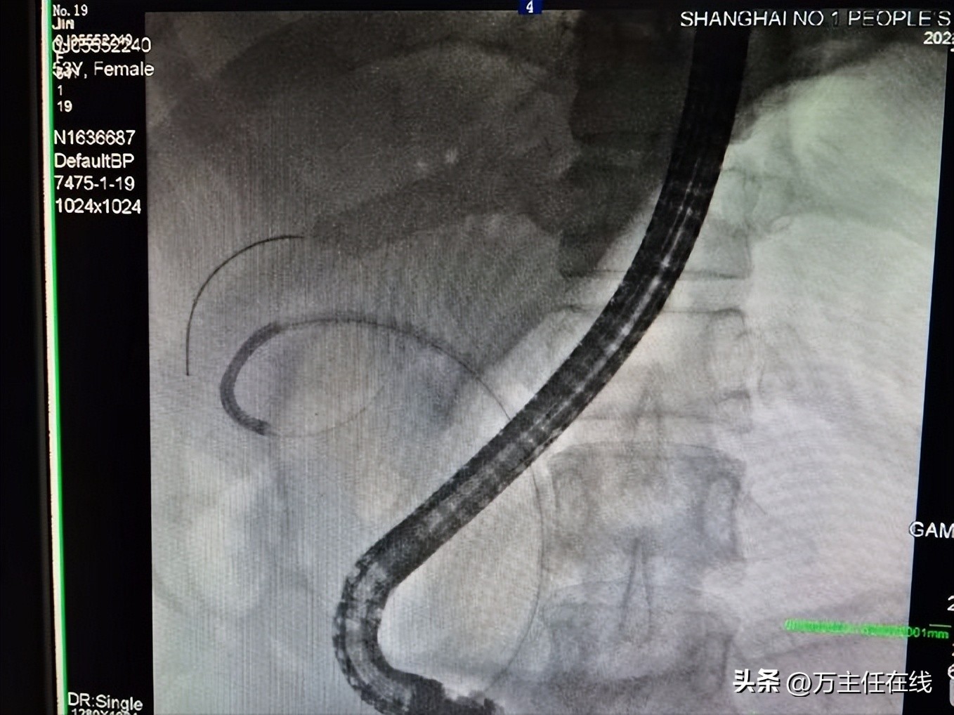 胆结石化脓性胆囊炎,妙手神针巧治疑难杂症