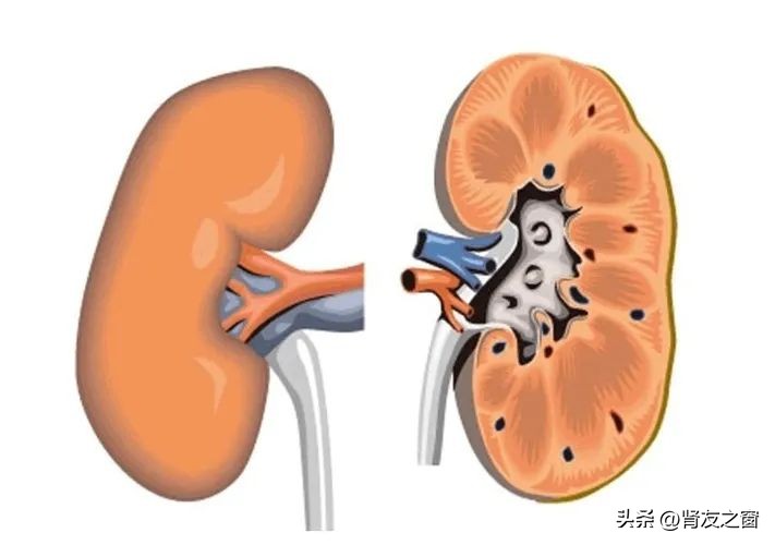 什么是肾盂肾炎?它的“元凶”是谁?
