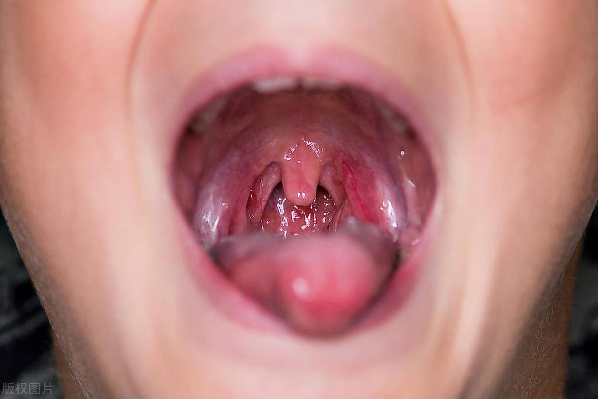 口臭原因大揭秘如何解决口臭问题,口臭的原因以及怎么消除口臭