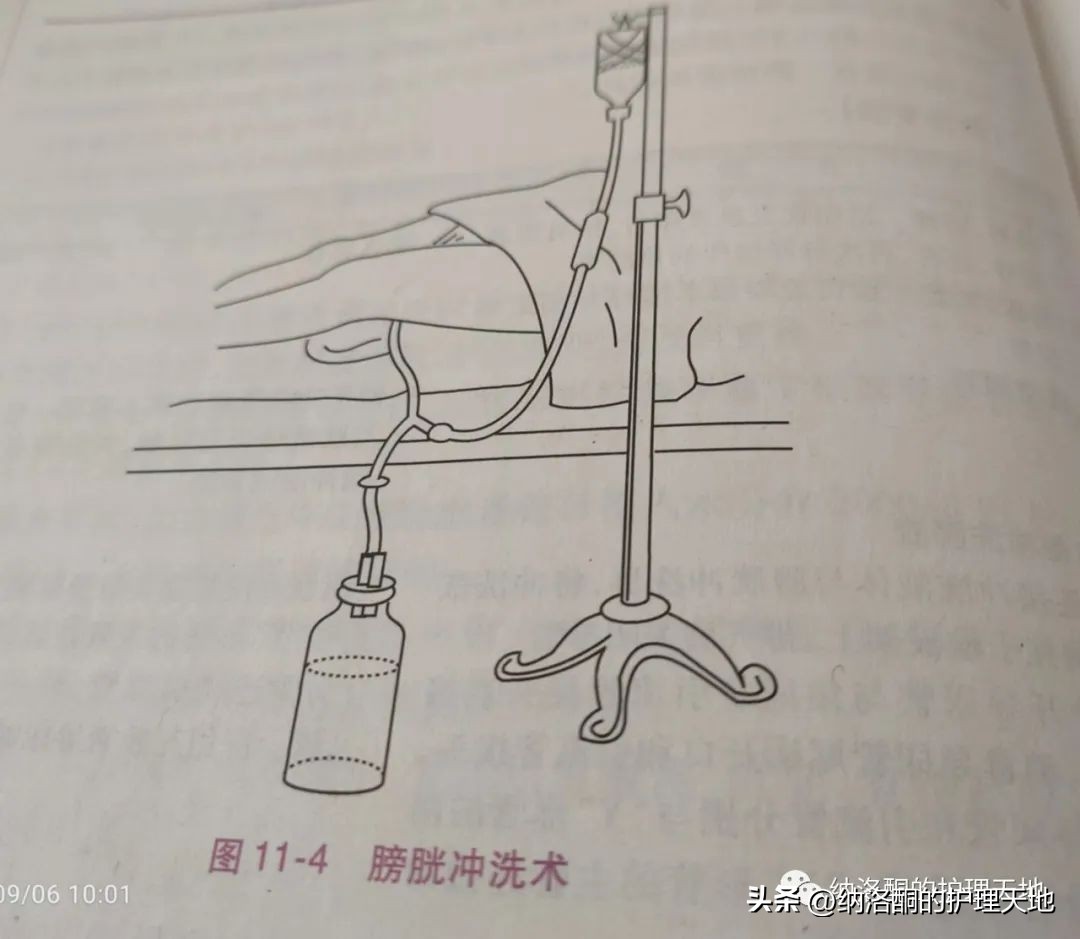 留置导尿管的固定技巧,留置尿管应取什么体位
