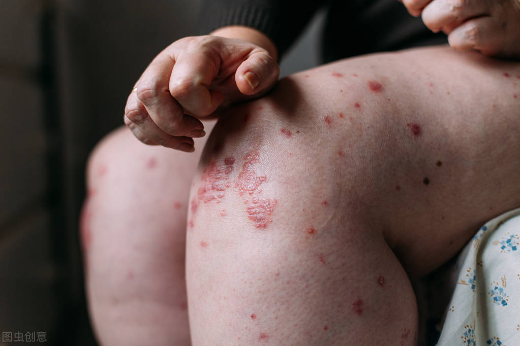 引起湿疹加重的八种因素,哪些原因会诱发湿疹