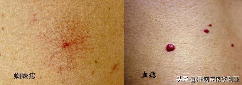 皮肤长痘肝癌征兆,肝癌会脸上长痘吗女性