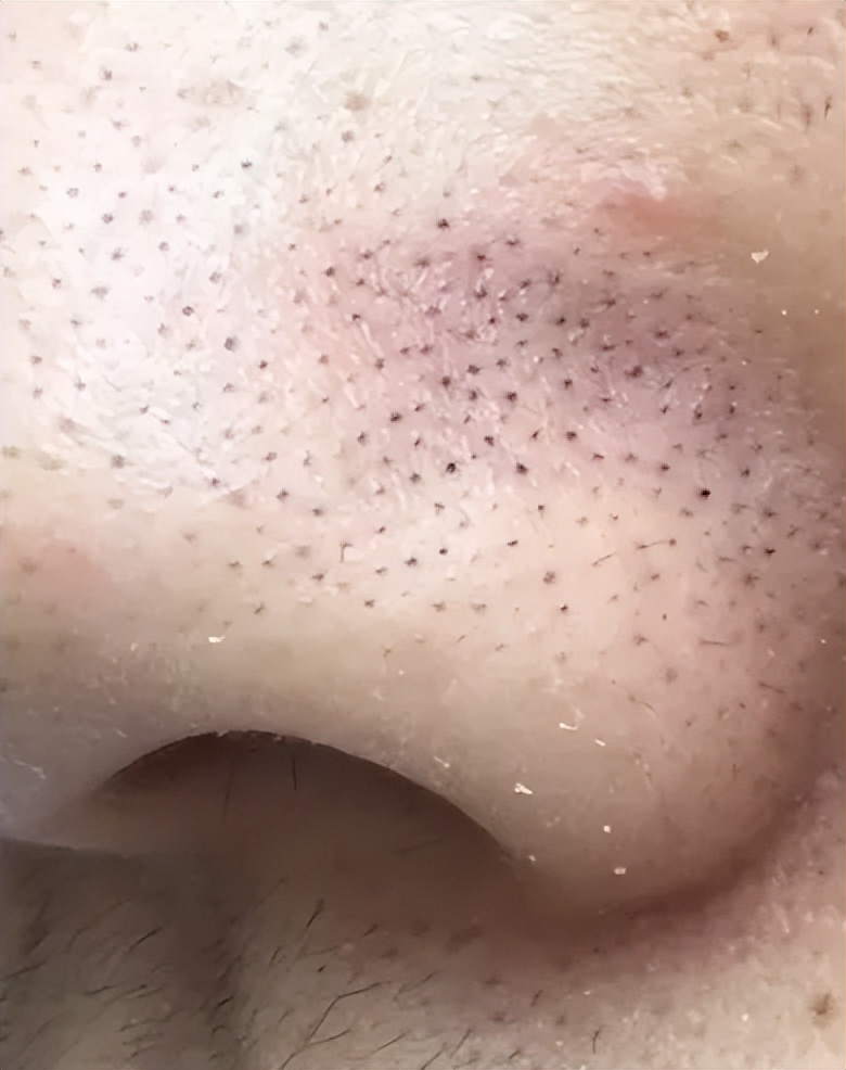 鼻子毛孔粗大黑头泛红怎么解决,鼻翼两侧有黑头还泛红如何护肤