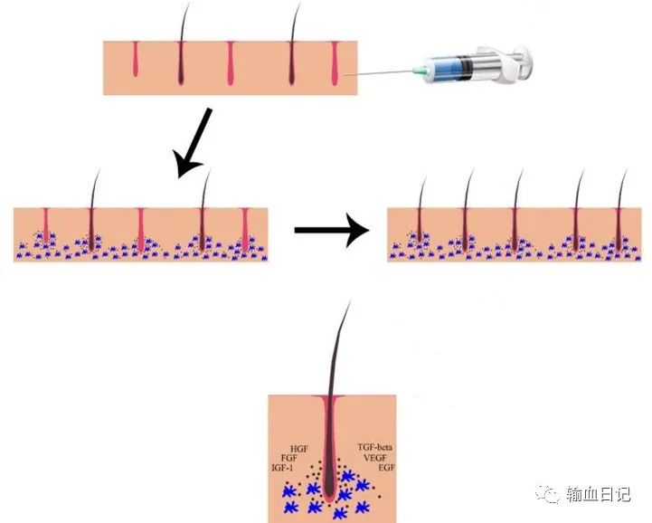 富血小板血浆治疗骨质增生吗,富血小板治疗脂溢性脱发