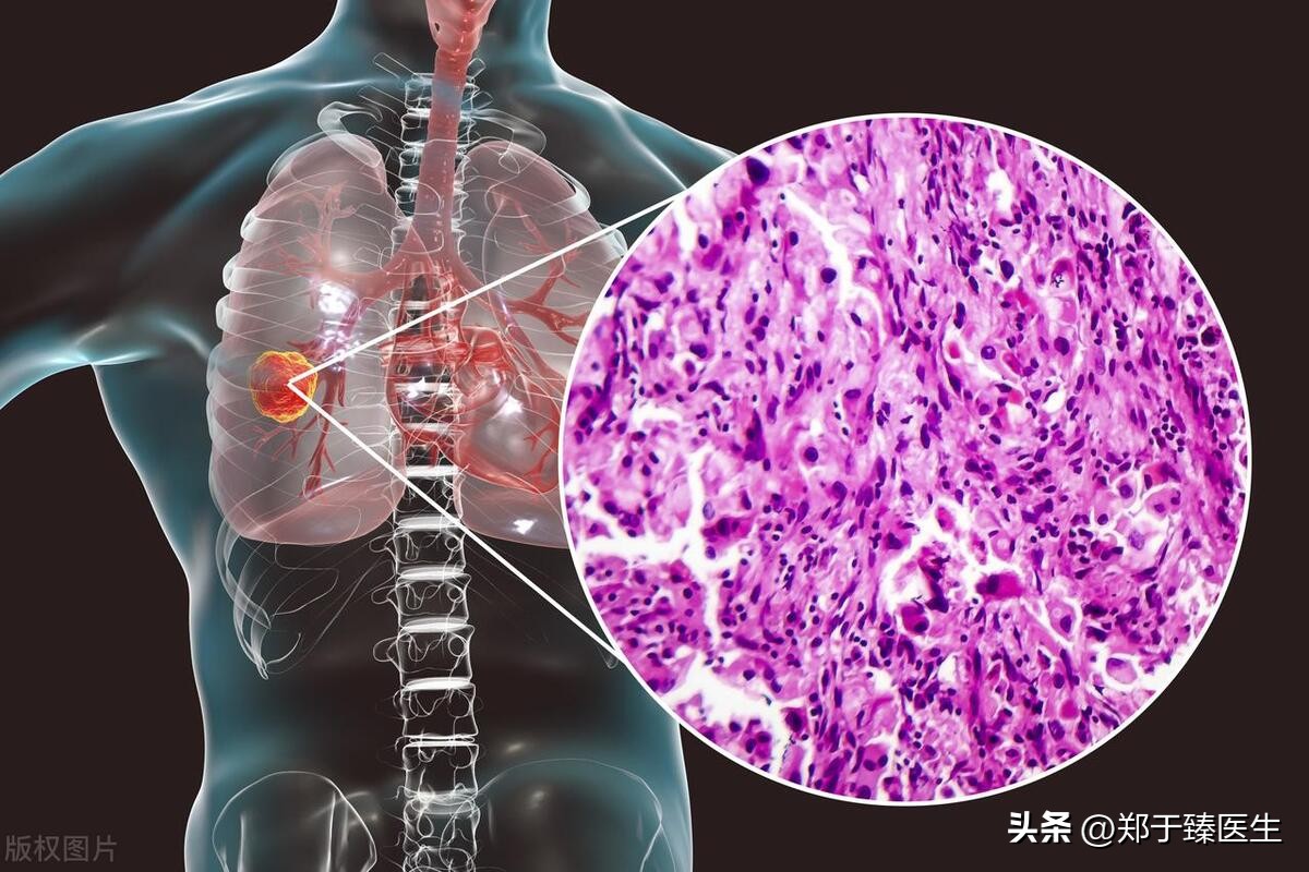 smarca-4缺陷型肺癌早期能手术吗,早期肺癌手术前一定要做petct吗