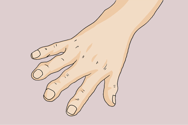 早上起来手肿胀难握拳怎么办,早起手指僵硬怎么回事