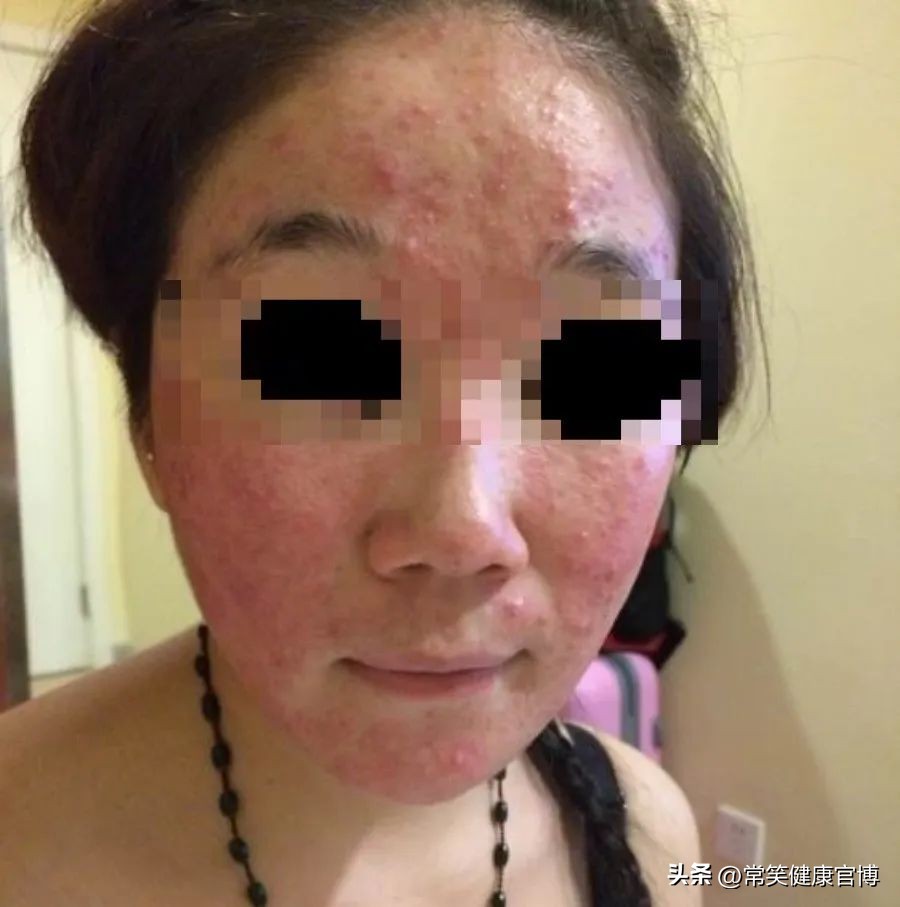 激素依赖性皮炎怎么才可以治愈,激素依赖性皮炎高发期如何缓解